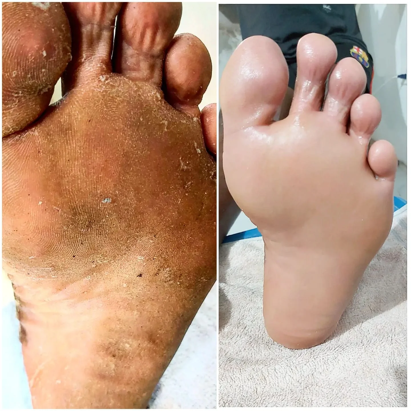Forefoot before and after callus removal