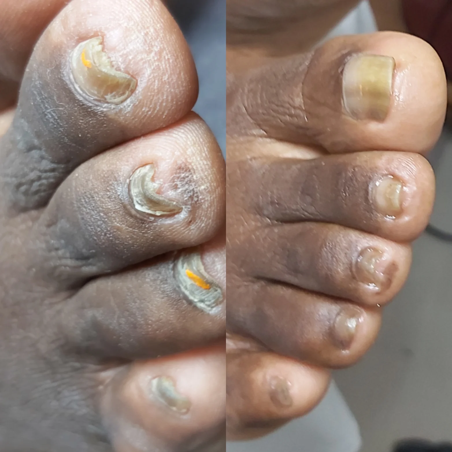 Toenails before and after fungal nail care