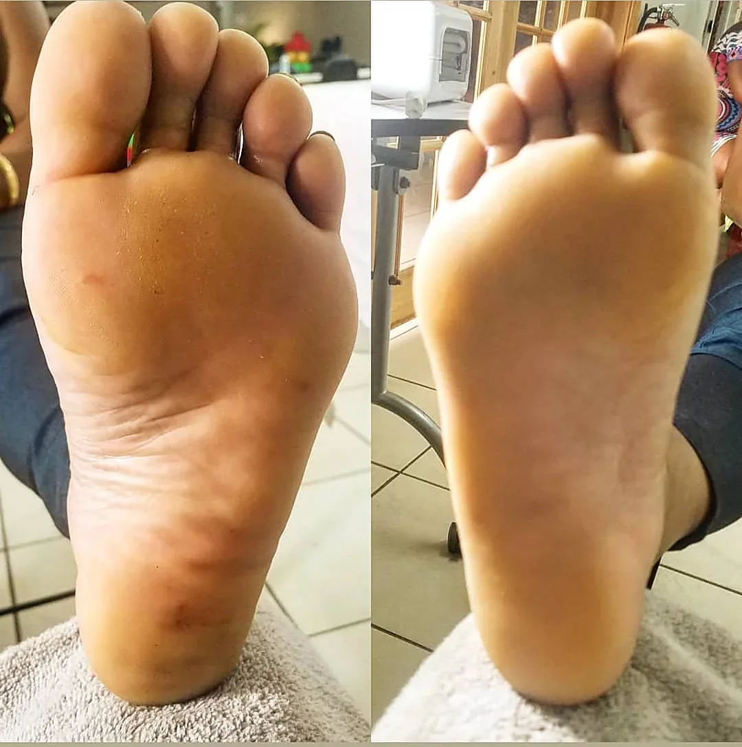 Feet before and after a waterless medical pedicure